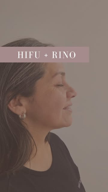 Tratamiento HIFU y armonización